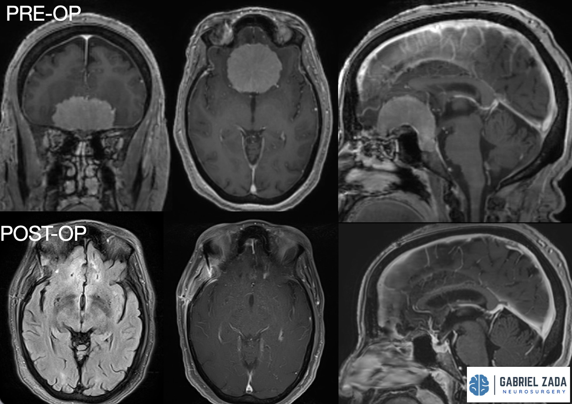 Meningioma Surgery Treatment In Los Angeles — Gabriel Zada